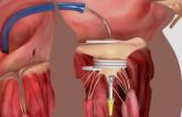 Early Results for Dock-Plus-Valve Approach Promising in Transcatheter Mitral Valve Replacement